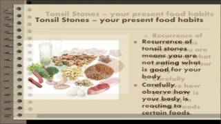 Tonsil stones removal  Natural tonsil stones home remedy [upl. by Liborio]