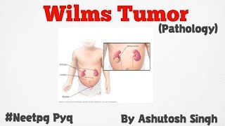 Wilms Tumor For 2nd year University Exams [upl. by Isherwood]