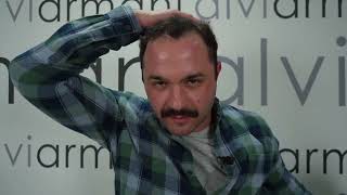 Dewie van der Merwe  Alvi Armani Hair Transplant [upl. by Hedaza]