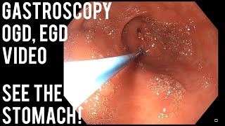 Gastroscopy  OGD  See inside the stomach [upl. by Cousin]