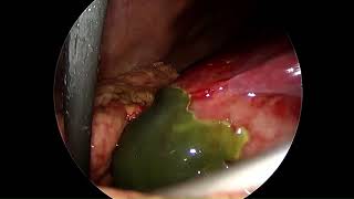 Laparoscopic Cholecystectomy in Gangrenous Gall Bladder [upl. by Chevy309]