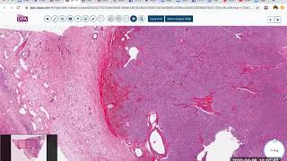 Steroid cell tumor of the ovary [upl. by Nosreve]