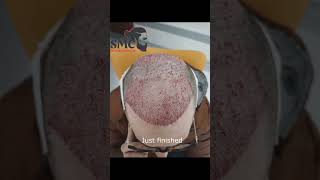 Hair Transplant results SMC hairtransplant [upl. by Lrac380]