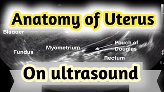 Sonographic Anatomy of UterusGyneacological ultrasound [upl. by Auburta666]