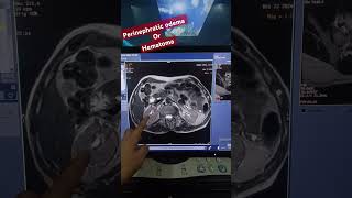 MRI KIDNEY SCAN MRI KIDNEY HEMATOMA or Perinephric Odemamri upper abd [upl. by Heidt]