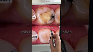 Caries treatment  tooth restoration [upl. by Nrublim69]