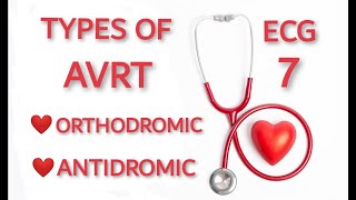 AVRT TYPES ORTHODROMIC AND ANTIDROMIC [upl. by Buke245]