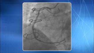 Chapter 6 Cannulation of the Coronary Ostia [upl. by Doscher]