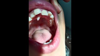 supernumerary teeth treatment  extra teeth treatment subscribe like 🦷 [upl. by Tesil491]