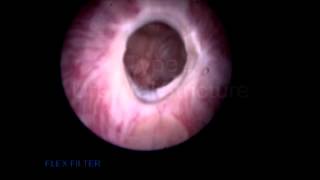 New staging system for anterior strictures [upl. by Drofla]