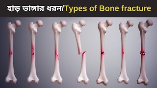 Common types of Bone fracture  3D animation  Bangla [upl. by Yablon]