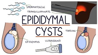 Understanding Epididymal Cysts [upl. by Tegdirb]