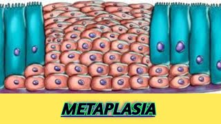 Metaplasia mechanism and examples  Dysplasia aplasia hypoplasia [upl. by Kassey]