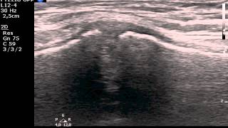 Manubriosternal joint MSKUS ultrasound [upl. by Ahsha]