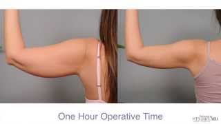 Get Firm Sculpted Arms With Smartlipo™  Dr Sterry Explains [upl. by Anialram189]