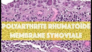 POLYARTHRITE RHUMATOÏDE  MEMBRANE SYNOVIALE  PATHOLOGIE [upl. by Alrep]