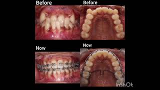 Progress in orthodontic treatment [upl. by Nylla]