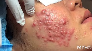 Cystic Pustules Acne Extractions EP14 No Clickbait [upl. by Dat]