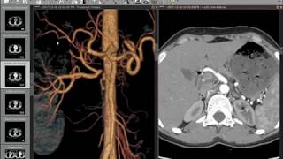 CT Angiography Case17 Renal Artery Stenosis  Renal Doppler and CTA [upl. by Josefina]