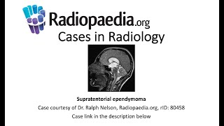 Supratentorial ependymoma Radiopaediaorg Cases in Radiology [upl. by Goulder]