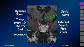 MedPix Video  Supratentorial Lesions [upl. by Afrika]