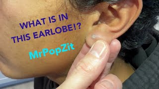 Chronic inflammatory earlobe nugget excised You can see scar ingrown hair and cyst formation [upl. by Marcile]