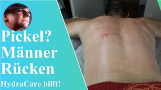 HydraCare Behandlung für Pickel und Juckreiz auf dem Männerrücken  BodyDream Kosmetikstudio [upl. by Valenza]