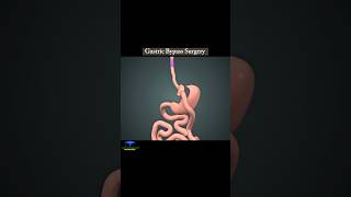 Gastric Bypass Surgery amp Gastric Sleeve Weight Loss Surgery shorts [upl. by Emerick406]