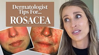 Dermatologist’s Guide to Rosacea What Is It Dos amp Don’ts Treatment Tips amp More  Dr Sam Ellis [upl. by Ellevehs]