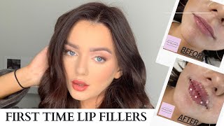 VLOG  FIRST TIME GETTING LIP FILLER what to expect when getting your lips filled  Russain Lip [upl. by Ardna]