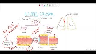 Pleural effusionTransudate vs exudate Light criteria [upl. by Ihsoyim]