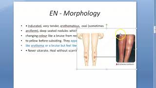 Medicine 9287 Erythema nodosum skin cause EN Dermatology ENL leprosy leprosum [upl. by Bendicta]