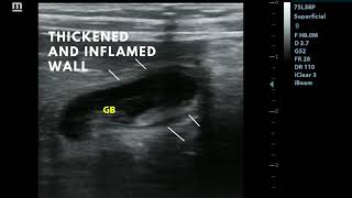 Cholecystitis [upl. by Nairda]