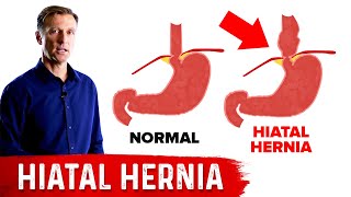 Hiatal Hernia The Best Home Treatment [upl. by Acirtal]