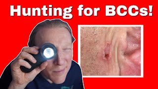 BCC Basal Cell Carcinoma Skin Cancer What You NEED to KNOW [upl. by Hyrup558]