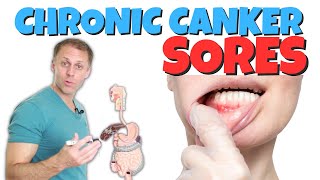 Dealing with Chronic Canker Sores [upl. by Meehsar]