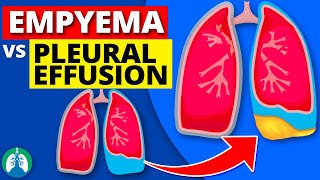 Empyema vs Pleural Effusion EXPLAINED [upl. by Homovec156]