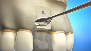 Bone Grafting Procedure Video Animation  Durham Dental Solutions [upl. by Archibald]