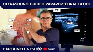 ULTRASOUNDGUIDED PARAVERTEBRAL BLOCK [upl. by Coppola]