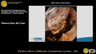 Percutaneous cholangioscopy for managing CBDS post RYGB [upl. by Olivero151]