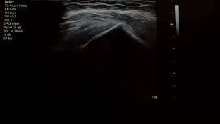 subacromial bursitis injection 24110101 [upl. by Heaps]