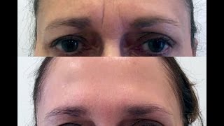 Forehead  Glabella quot11quot Rejuvenation with Botox and Restylane [upl. by Anitreb]