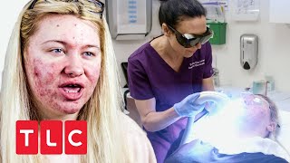 Laser gegen Akne  Dr Emma Hautärztin aus Leidenschaft  TLC Deutschland [upl. by Sweeney]