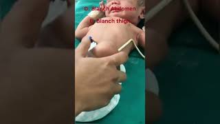 How to check for jaundiceicterus in a newborn [upl. by Lindner125]