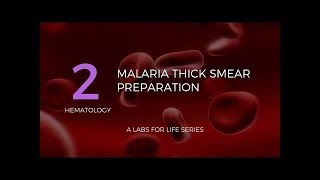 Malaria Thick Smear Preparation [upl. by Januisz86]