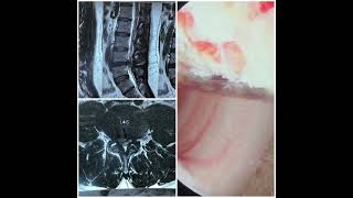 Endoscopic spine surgery pune doctor spinespecialist roboticspinesurgery hospital backinjury [upl. by Froehlich]