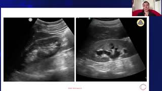 Hydronephrosis vs Normal Kidney [upl. by Cormac]