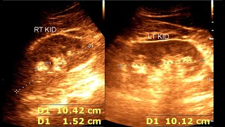 Angiomyolipoma  Renal Mass  Renal Tumor [upl. by Fokos539]