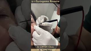 Syringoma removal by LASER syringoma treatment laser awishclinic delhi drvijaykumar shorts [upl. by Mercie]