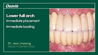 Clinical Case Lower full arch immediate placement amp loading [upl. by Stalk934]